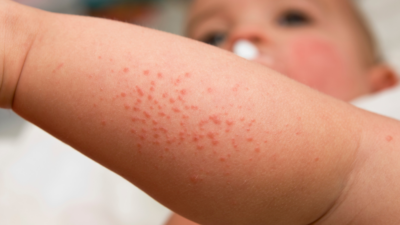 Cazuri de rujeolă în creștere în România, vaccinarea rămâne esențială