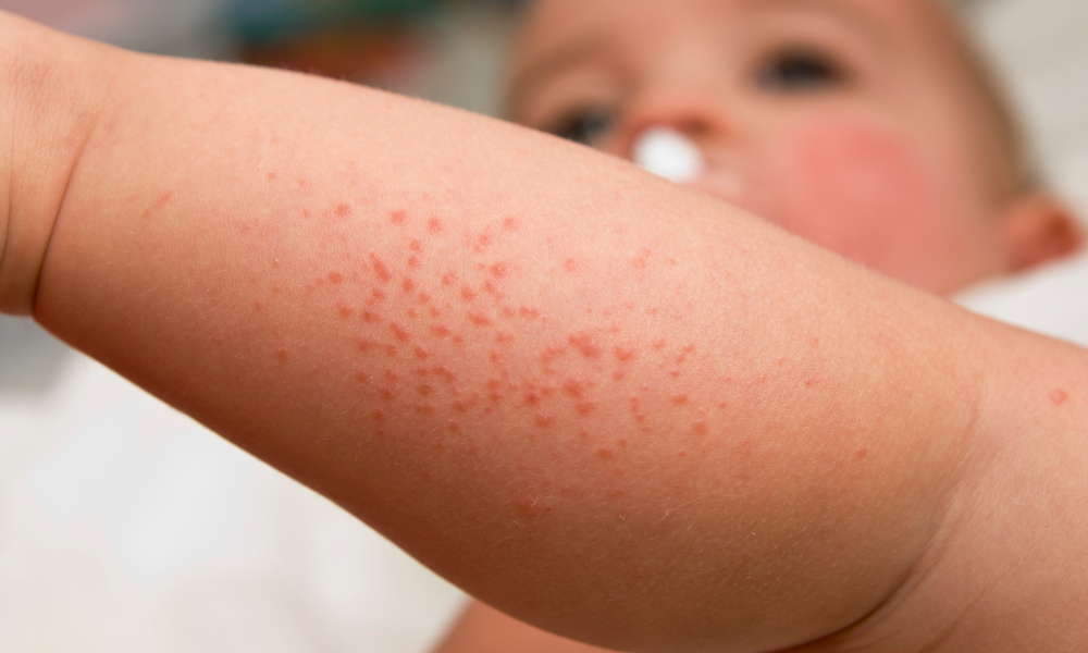 Cazuri de rujeolă în creștere în România, vaccinarea rămâne esențială